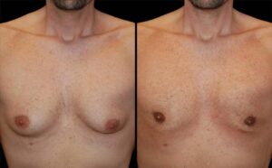 Paciente 35 años – 1 mes después