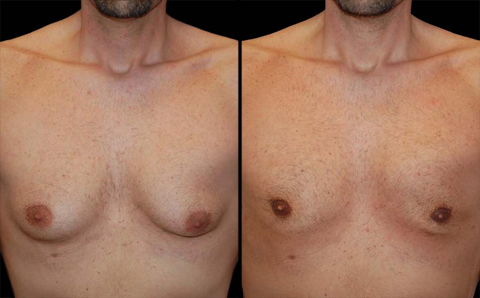 Paciente 37 años – 1 mes después